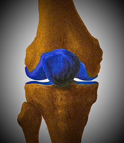 Meine Erfahrungen mit Arthrosamid